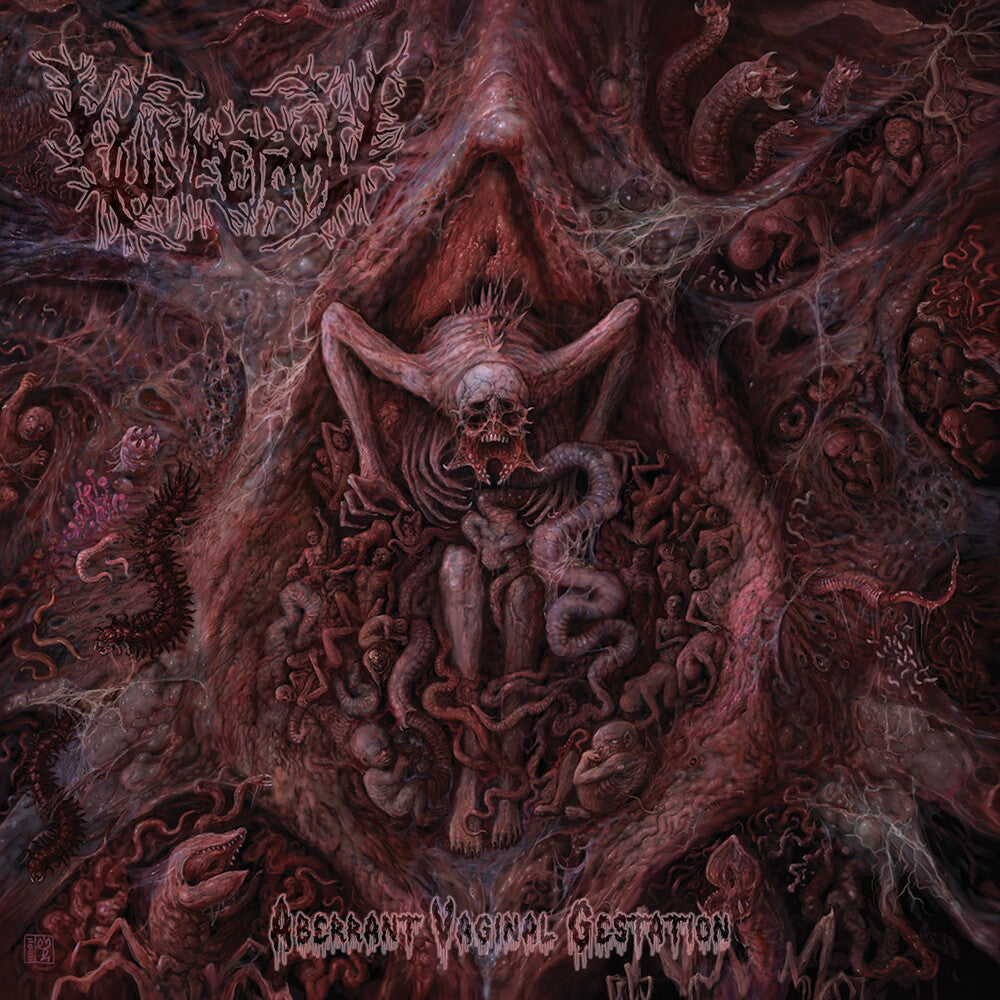 Vulvectomy - Aberrant Vaginal Gestation [CD]